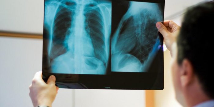 radiologue et radio des poumons