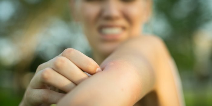 close up of a red mosquito bite on a person's arm, rubbing and scratching it outdoor in the park