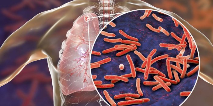 Tuberculose : les signes à repérer
