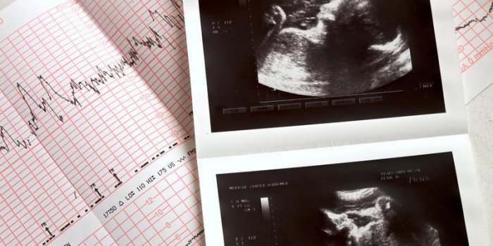 L-hydrocephalie chez le fœtus se voit-elle a l-echographie ?