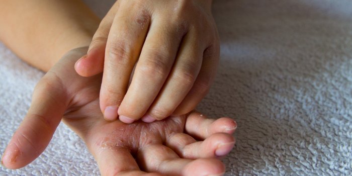 Eczéma ou mains sèches : comment faire la différence ? 