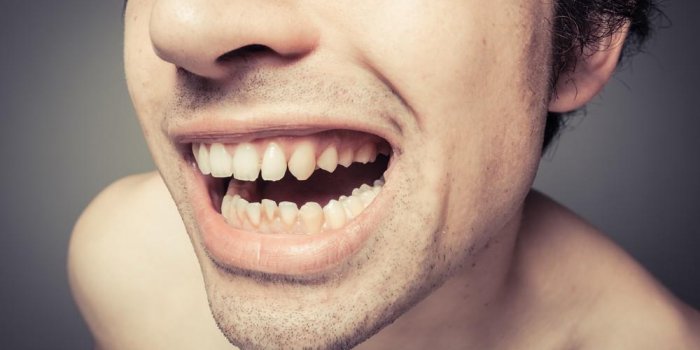 jeune homme montre ses dents sales avec accumulation de plaque