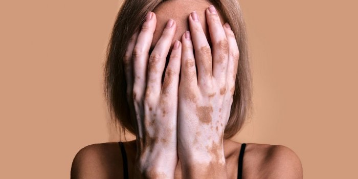 Vitiligo : comment reconnaître les premiers signes ?