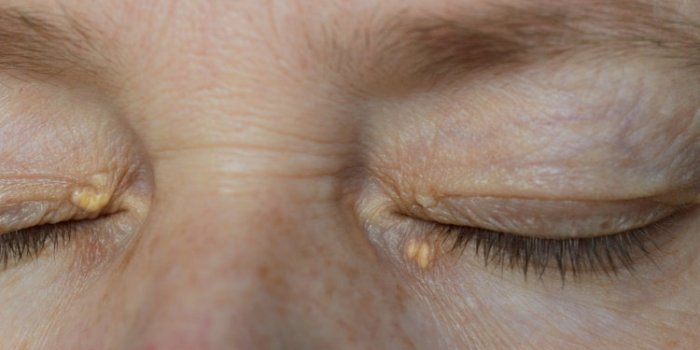 close up of woman eyes with xanthelasma on the eyelids hypercholesterolemia, high cholesterol