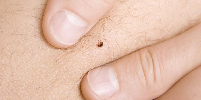 Maladie de Lyme : reconnaître la lésion typique de l’infection 