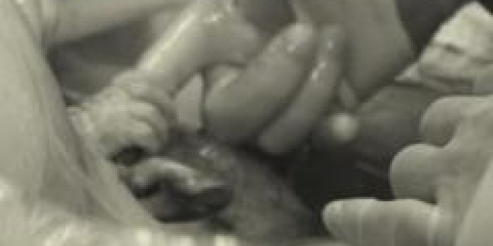 Image étonnante : un nouveau-né serre le doigt du chirurgien en pleine césarienne