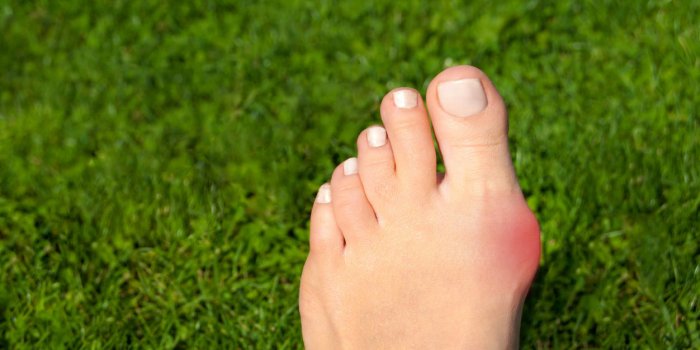 hallux valgus, bunion in woman foot on grass background