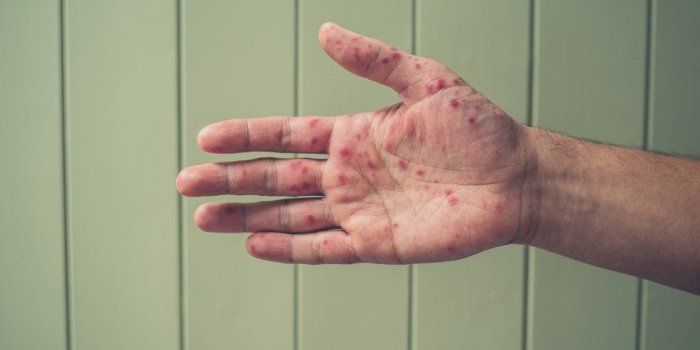 Sénégal : la mystérieuse maladie de peau touchant des pêcheurs serait-elle la varicelle ? 