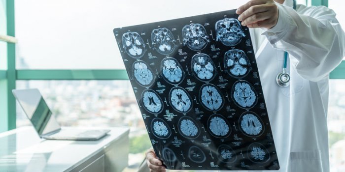 Canada : 42 personnes touchées par une maladie du cerveau inconnue