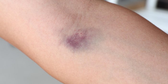 black bruised elbow from injection blood test , needle