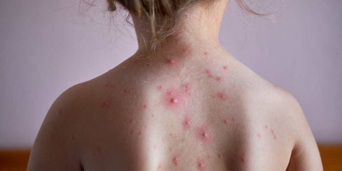 little girl with a chickenpox on her back