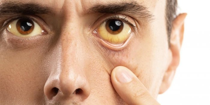 man checking his health condition yellowish eyes is sign of problems with liver, viral infection or other disease