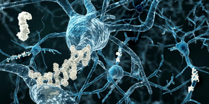 plaques amyloïdes sur les axones des neurones touchés par la maladie d'alzheimer