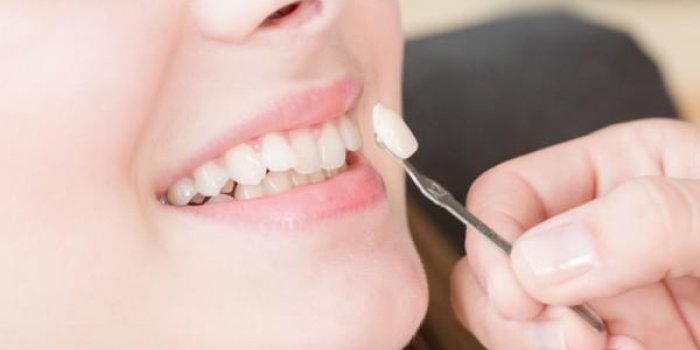 Protheses dentaires fixes : peuvent-elles tomber ?