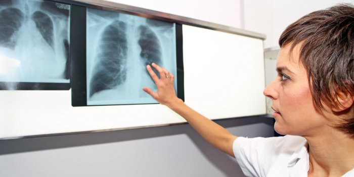 Embolie pulmonaire : 7 facteurs de risque à connaître