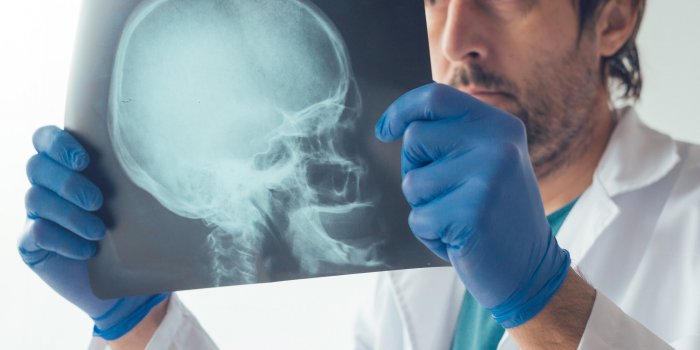 Passé 65 ans, les hommes subissent plus de fractures du crâne que les femmes