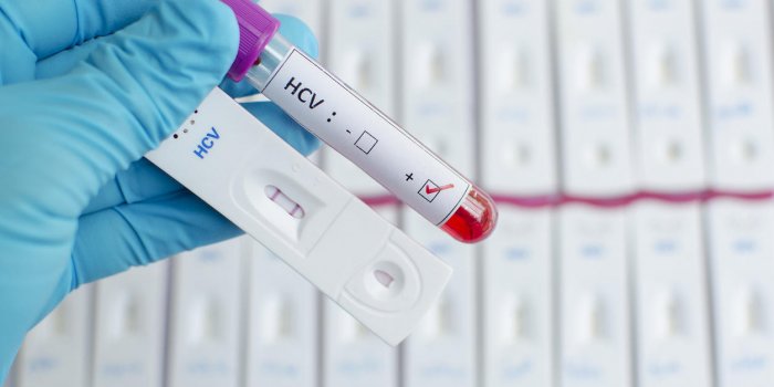test du virus de l'hépatite c (hcv) en utilisant une cassette de test, le résultat a montré positif (double ligne rouge)