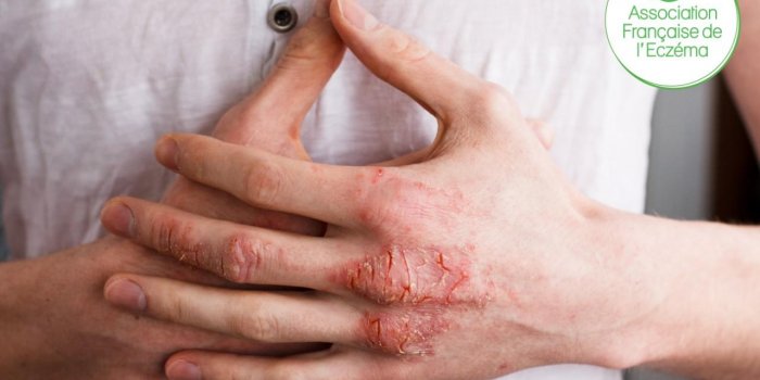 Eczéma chronique des mains : de fortes répercussions sur la vie des patients