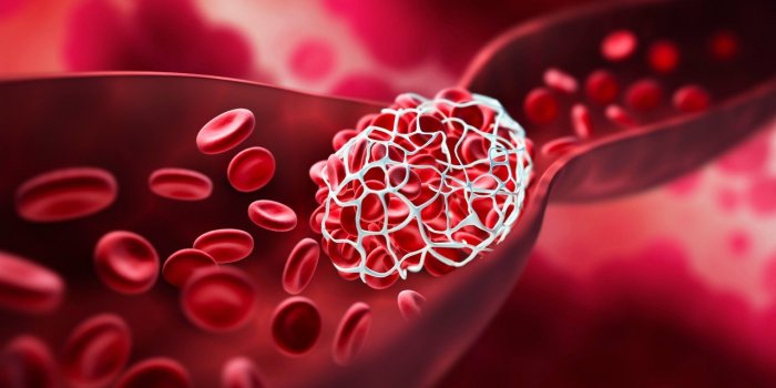 Caillots sanguins : un risque accru jusqu’à 6 mois après la covid-19