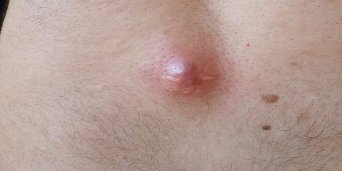 abscess furuncle carbuncle on male hairy back clogged pore leading to skin inflammation surgical solution of cosmetic pro...
