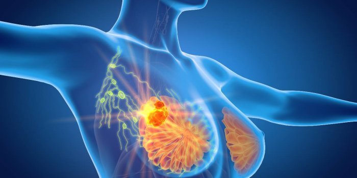 Cancer du sein : 7 aliments a eviter pendant la maladie