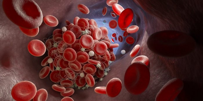 Thrombose veineuse : 8 comportements a risque selon l-Inserm