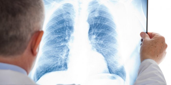 Cancer du poumon : 10 facteurs qui augmentent vos risques