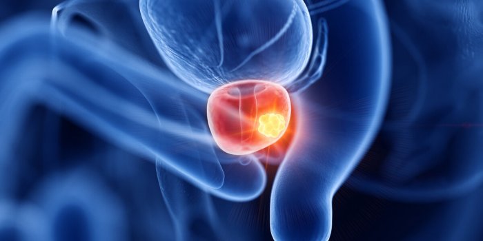 Cancer de la prostate : pourquoi le dépistage organisé n’est-il pas mis en place ?