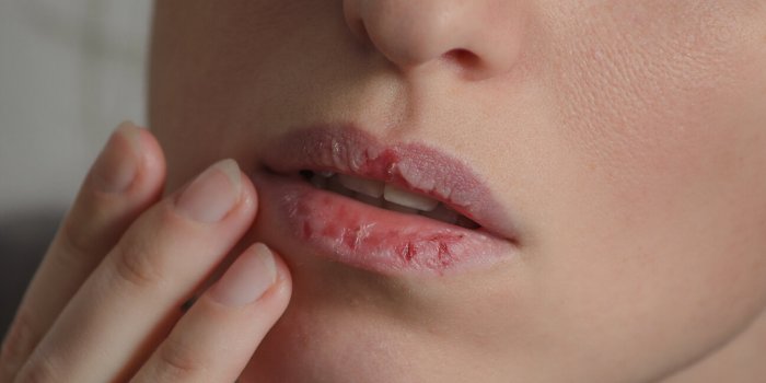 dermatillomania skin picking woman has bad habit to pick her lips harmful addiction based on anxiety stress and dry lips ...