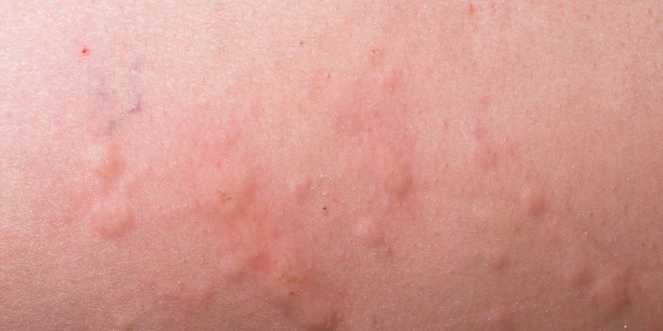 Allergie cutanée : symptômes, réactions, traitements aux éruptions cutanées