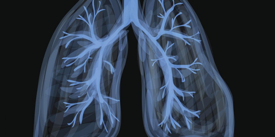 Bronchite asthmatiforme (asthmatique) : symptômes, causes, contagion et traitements