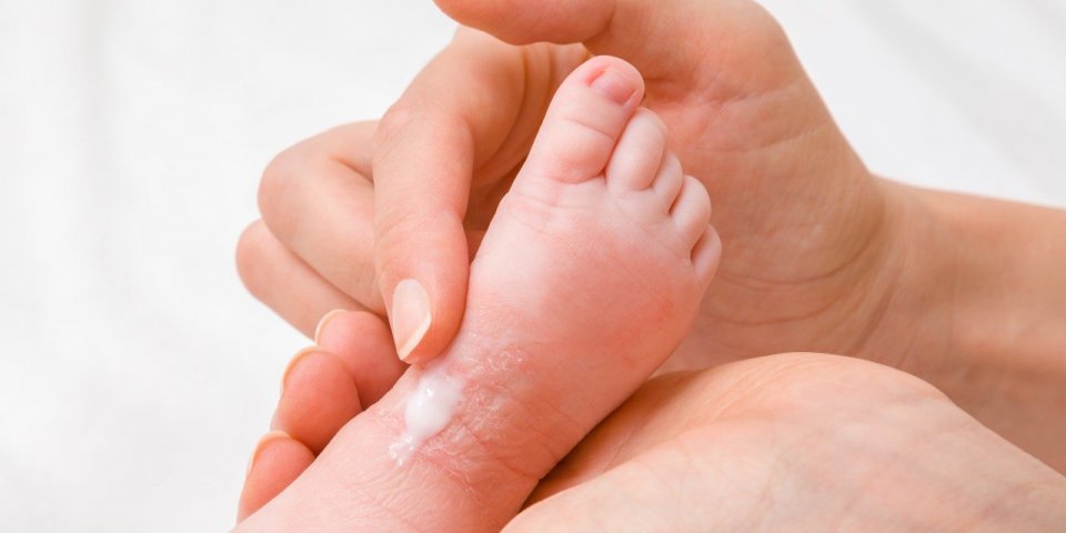 Eczéma du bébé : traitements, crèmes… Comment soulager votre nourrisson ? 