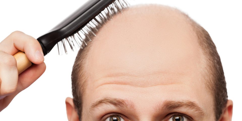 alopécie humaine ou perte de cheveux - main de l'homme adulte tenant peigne sur la tête chauve