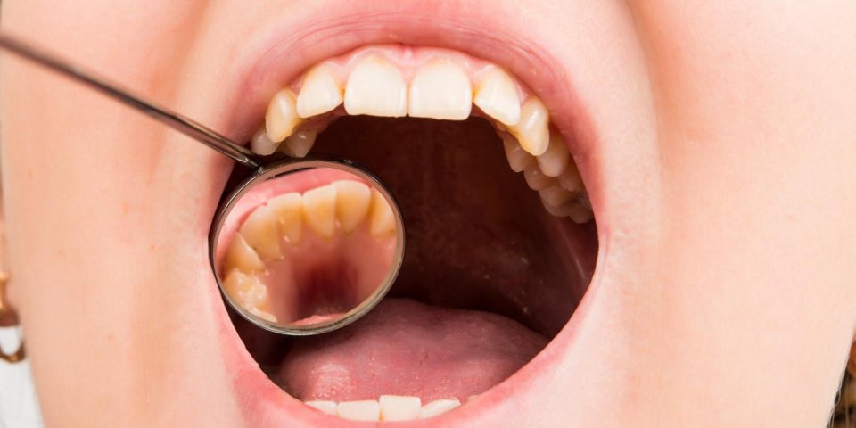 Glossodynie (douleurs à la langue) : quels traitements pour la soigner ?