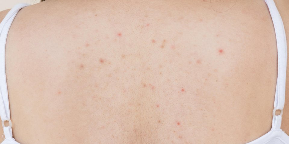health problem, closeup young girl acne on her back