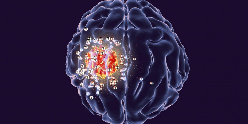 destruction de tumeur cérébrale par des nanoparticules, illustration 3d illustration conceptuelle de traitement du canc...