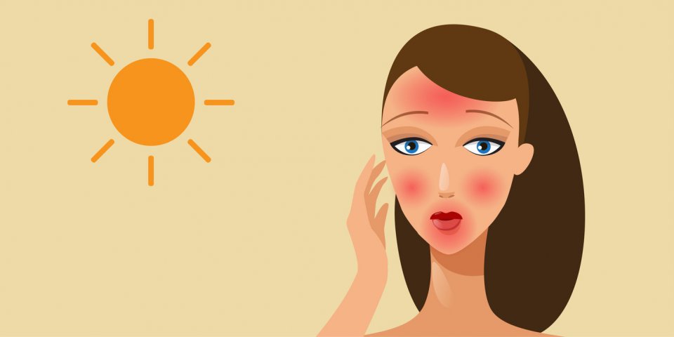 Coup de soleil au visage : 5 trucs à ne surtout pas mettre dessus 