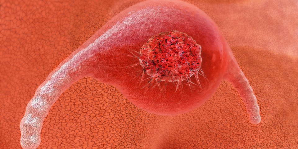 Cancer des ovaires et kyste ovarien : la différence