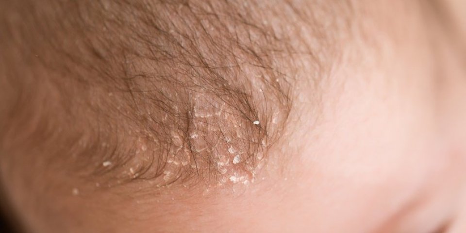seborrheic dermatitis on head of the baby newborn with seborrhea, close-up