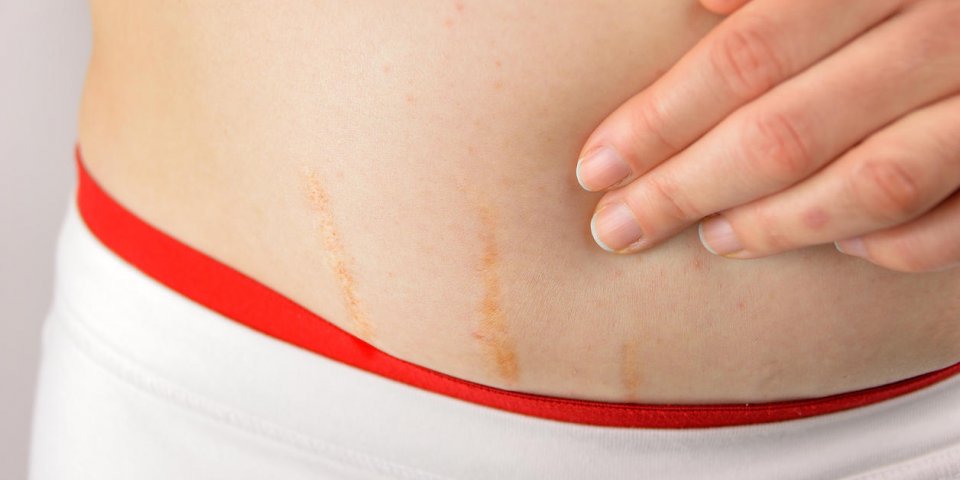 femme teste la peau sur son ventre en général la présence de vergetures