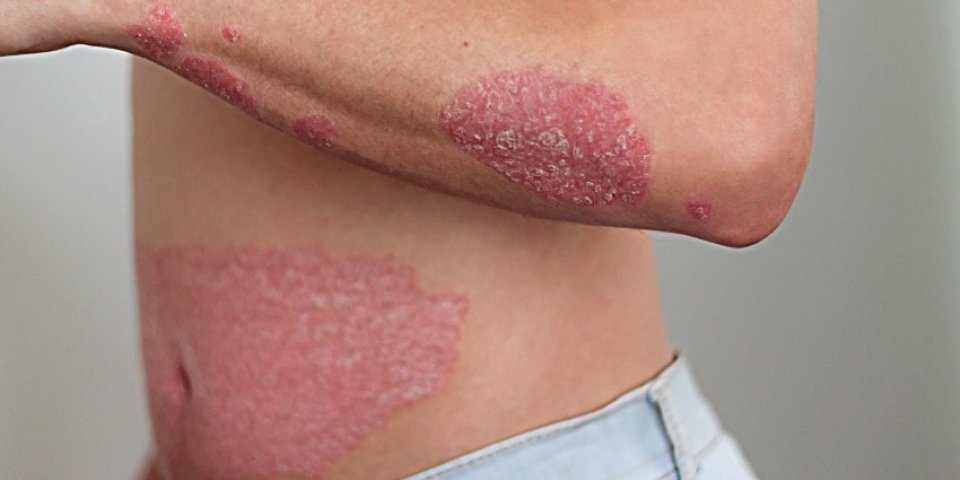 the man on the arm and abdomen spots psoriasis