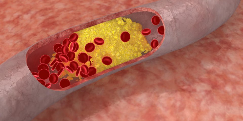 Le mauvais cholestérol favorise l'expansion d'un cancer