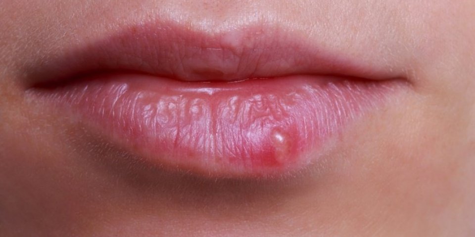 herpes on the lips of a young girl