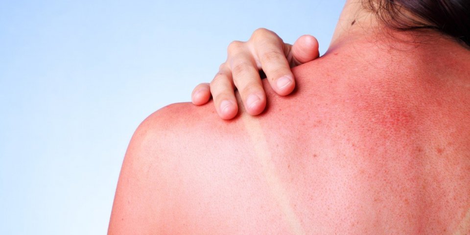Coup de soleil : une femme dévoile une effrayante cloque après avoir bronzé sans crème