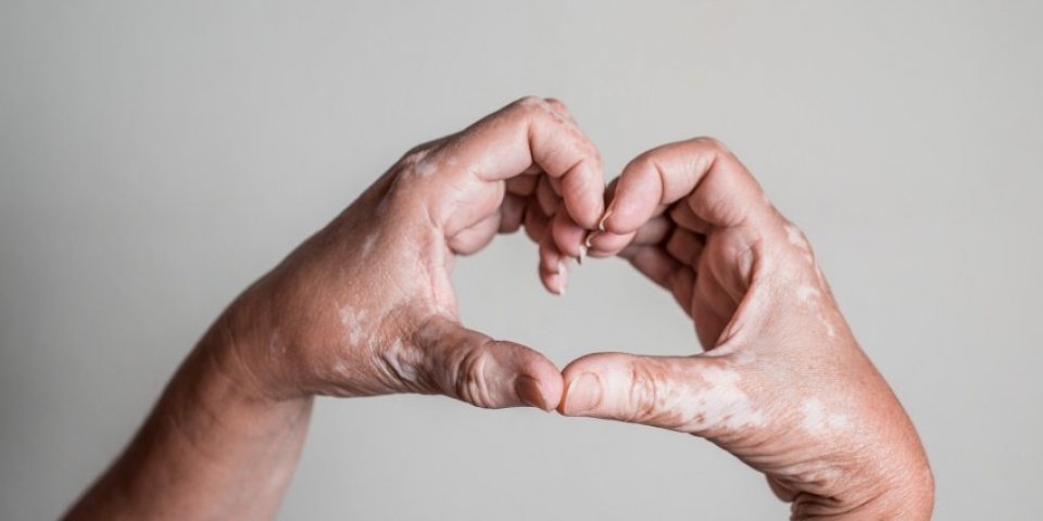 caucasian hands with vitiligo skin disorder forming a heart with fingers on isolated background