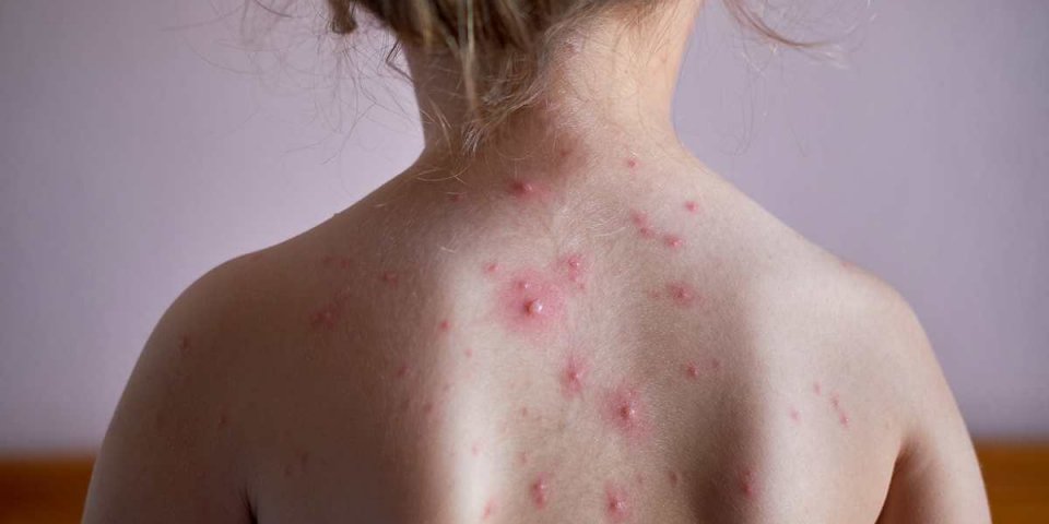 little girl with a chickenpox on her back