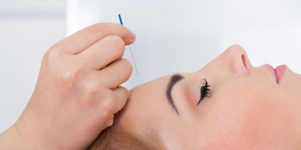 Céphalées : l'acupuncture, traitement miracle contre les maux de tête ? 