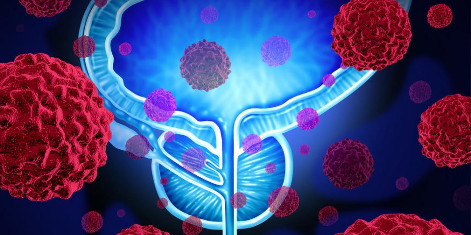 cancer de la prostate danger concept médical que les cellules cancéreuses dans un corps masculin attaquent le système ...
