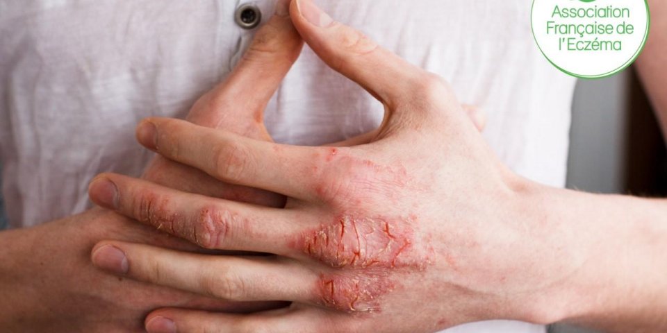 Eczéma chronique des mains : de fortes répercussions sur la vie des patients