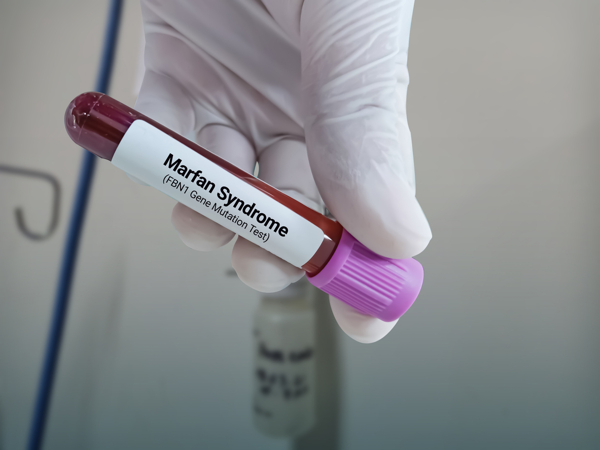 Syndrome de Marfan : ces caractéristiques physiques indiquent que vous pouvez en être atteint, comme l’était le général de Gaulle